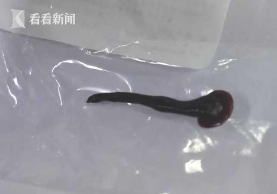 幼童做雾化咳出蚂蝗事件揭秘