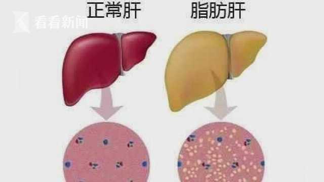 6岁男孩患上脂肪肝