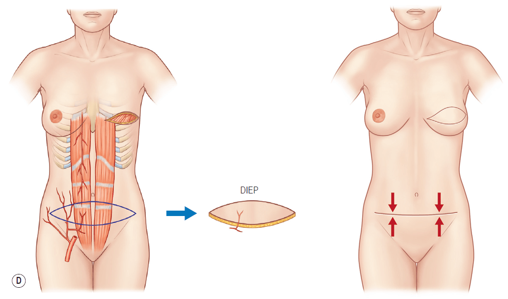 抗癌后女子用腹部赘肉再造乳房