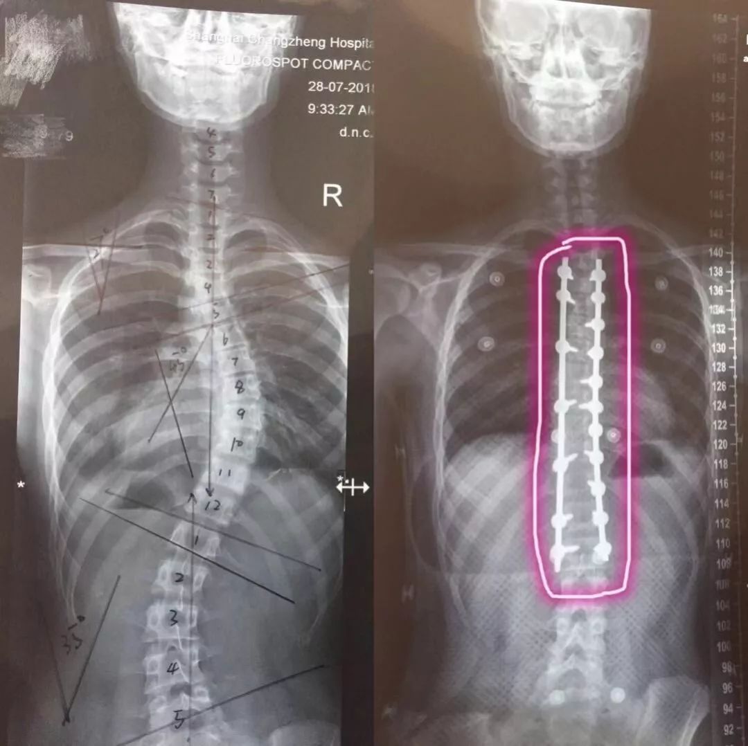 女孩脊柱侧弯80度